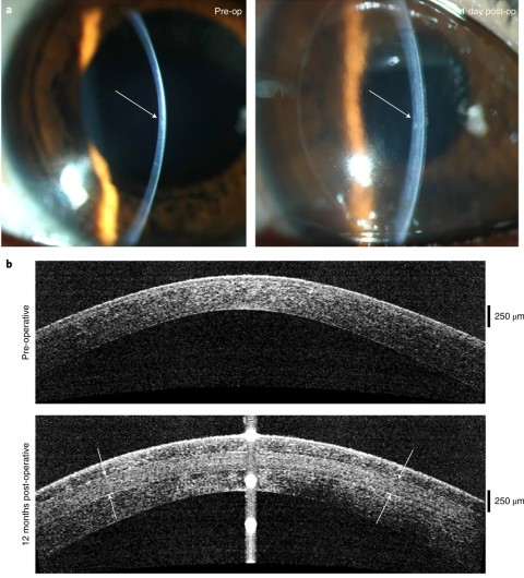 Photographs of a patient’s cornea before operation (left) and one day post-operation (right) with arrows indicating change in thickness and curvature in the central cornea.