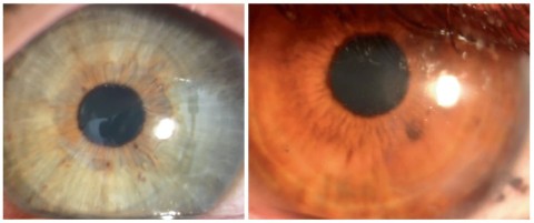 Photographs of eyes from two subjects with the corneal implant four months post-operation, showing that it retained transparency. 